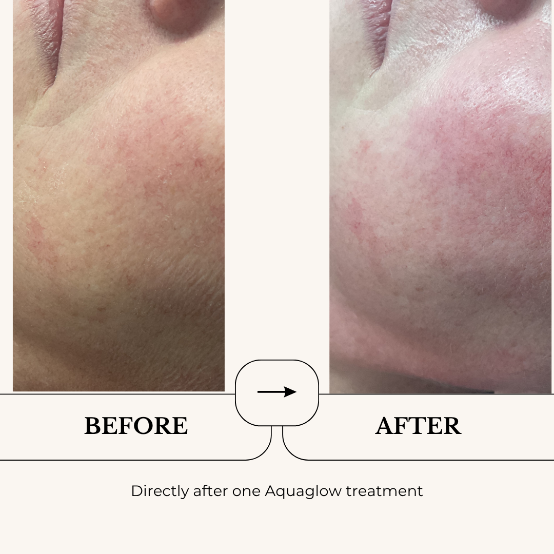 Aquaglow Hydra Facial before and after, directly after one treatment