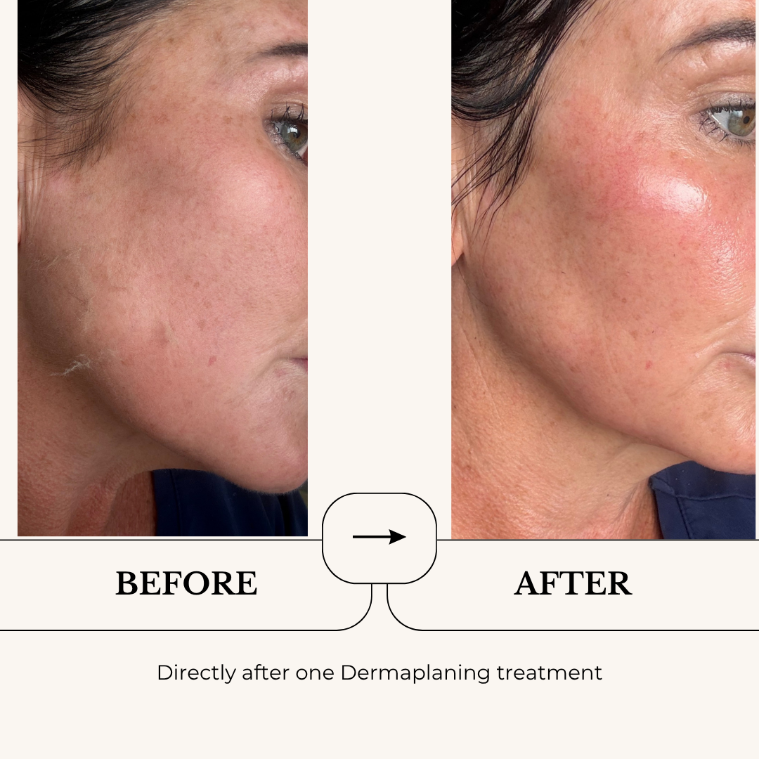Dermaplaning before and after, directly after one treatment