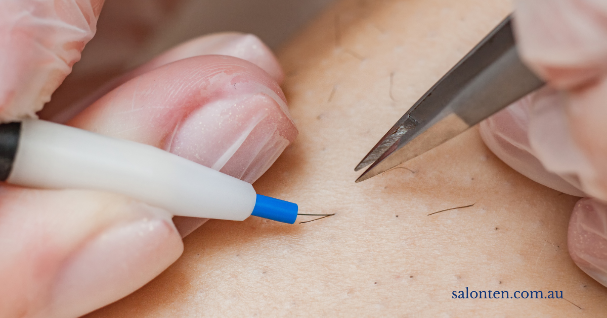 Electrolysis treatment: a fine probe treating a single hair follicle