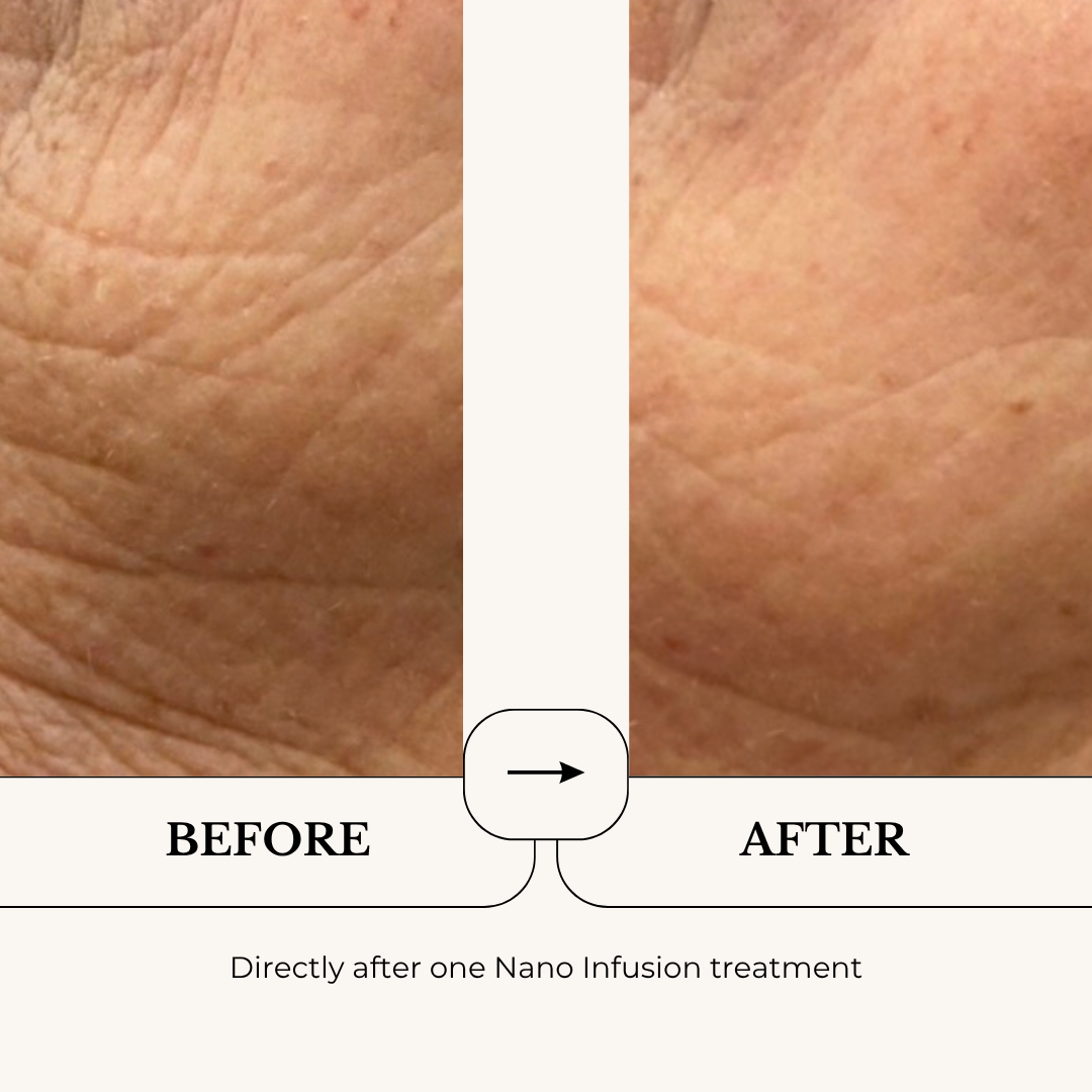 Nano Infusion Facial before and after, directly after one treatment