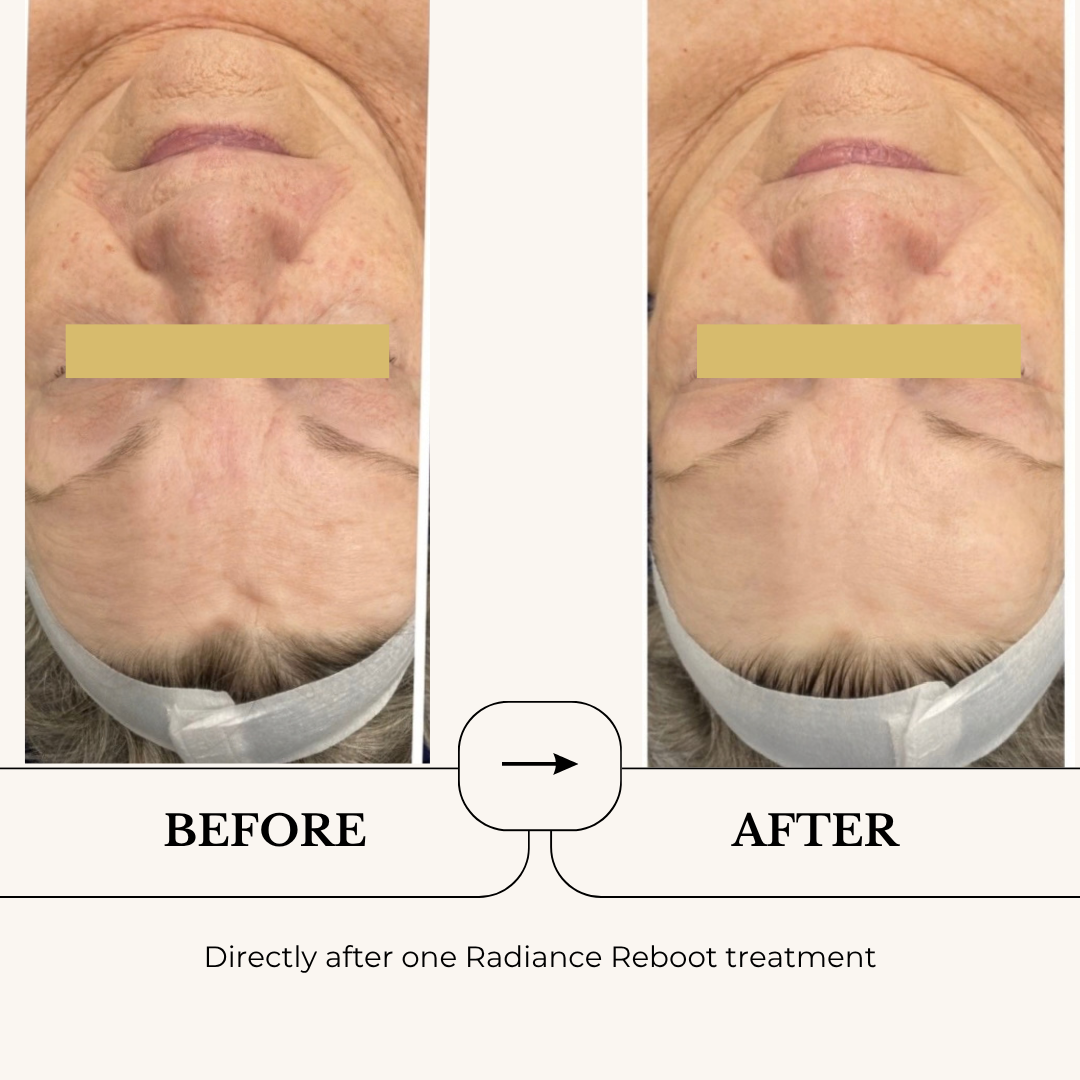 Radiance Reboot Facial before and after on a second client, directly after one treatment