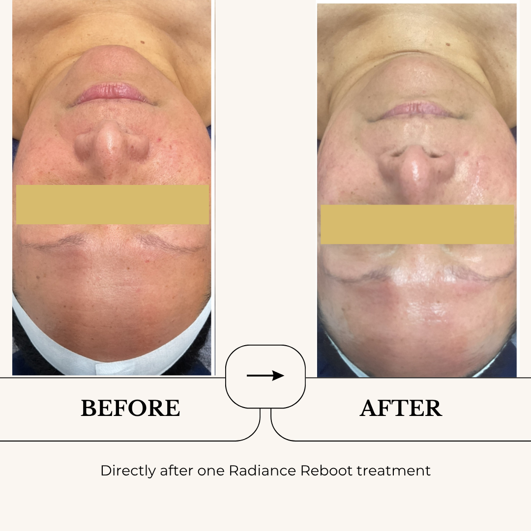 Radiance Reboot Facial before and after, directly after one treatment